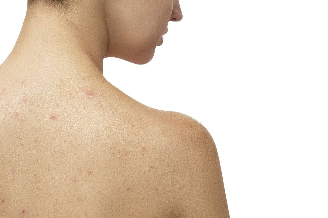 Find the Right Skin Care Products to Combat Back and Body Acne