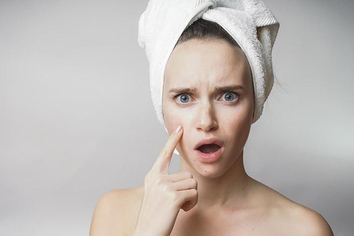 5 Expert Tips on How to Treat and Combat Adult Acne
