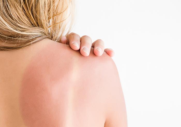 Caring for Sunburn in Inconvenient Places