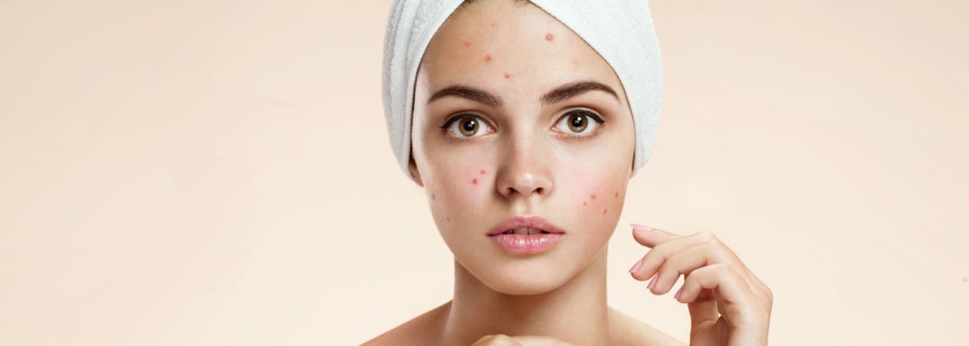 The Best Acne Skin Care Products for Adults and Teens