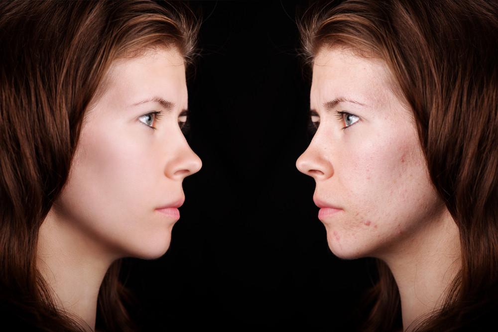 Choosing The Best Moisturizer For Acne Prone Skin: Not An Easy Task
