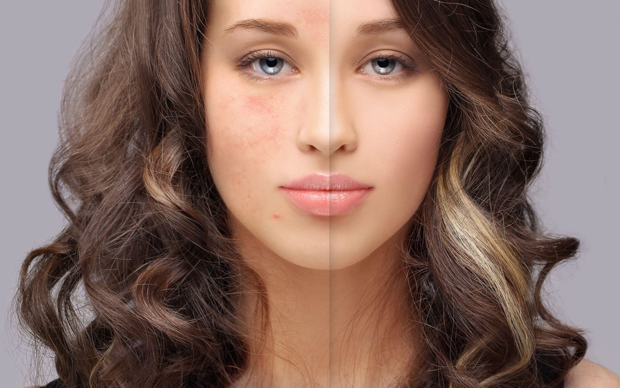 Makeup for Rosacea picture