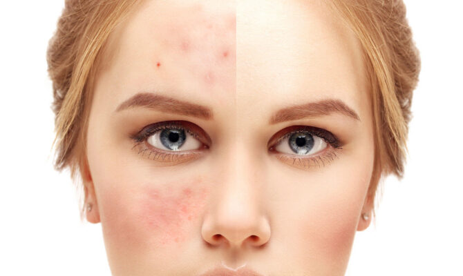 Rosacea Acne Skincare Routine